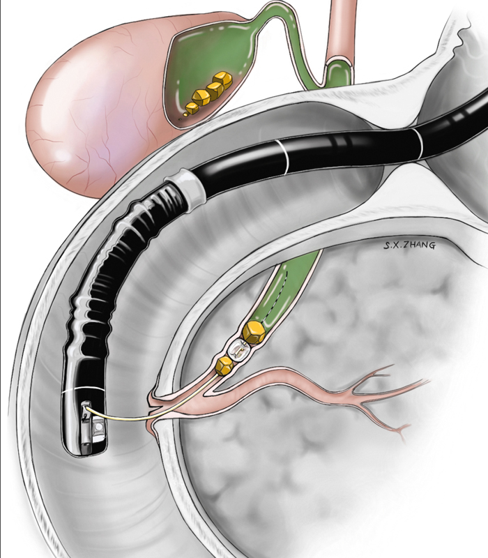 Trat-_0007_Colangiografía endoscopica